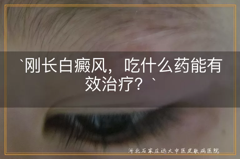 刚长白癜风，吃什么药能有效治疗？