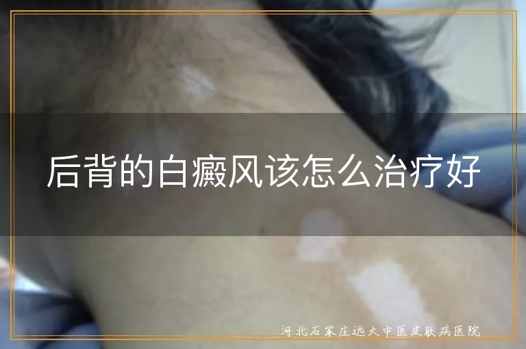 后背白癜风,治疗方法,药物治疗,光疗,激光治疗,手术治疗,中医治疗,日常护理,饮食调整,防晒措施