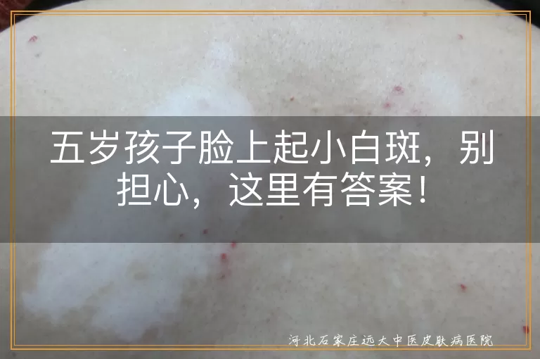 五岁孩子,脸上白斑,白色糠疹,白癜风,无色素痣,炎症后色素减退斑,护理,治疗