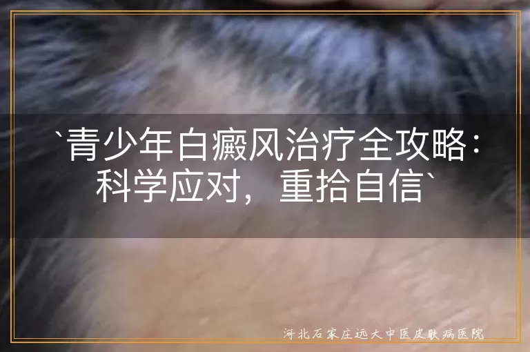 青少年白癜风治疗全攻略：科学应对，重拾自信