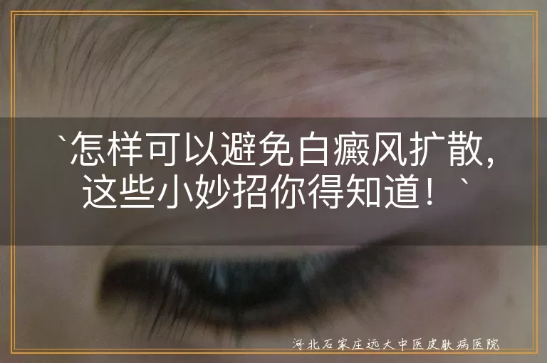 白癜风,扩散,日常护理,饮食