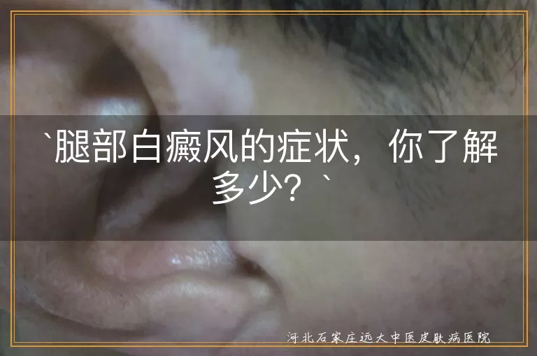 腿部白癜风的症状，你了解多少？