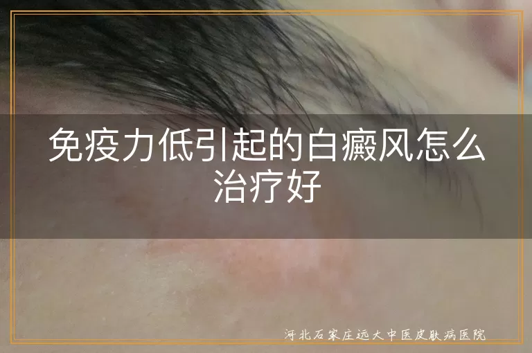 免疫力低引起的白癜风怎么治疗好