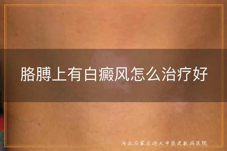 胳膊上有白癜风怎么治疗好