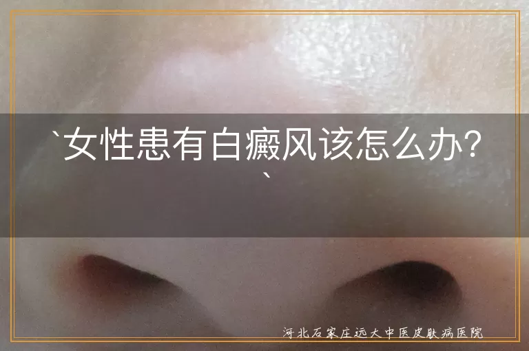 女性患有白癜风该怎么办？