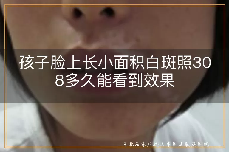 孩子脸上长小面积白斑照308多久能看到效果