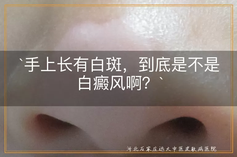 手上长有白斑，到底是不是白癜风啊？