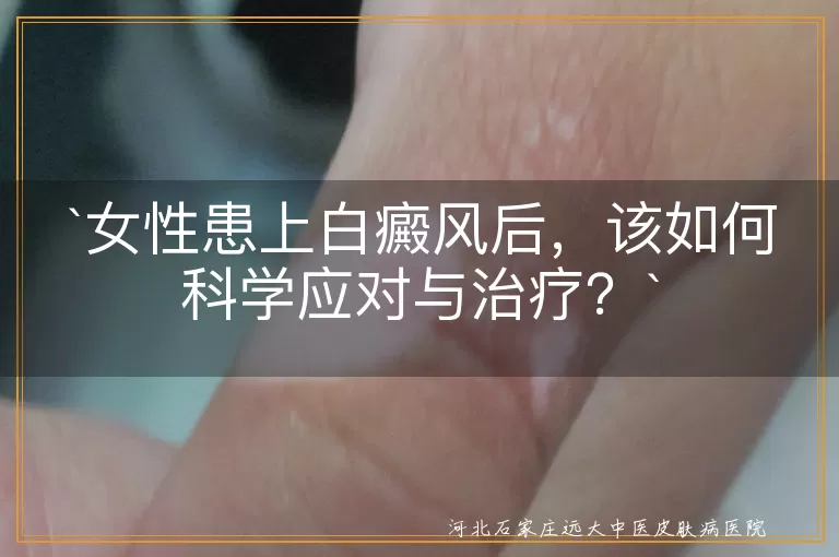 女性患上白癜风后，该如何科学应对与治疗？