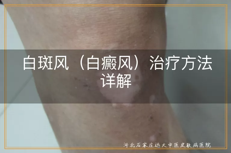 白斑风（白癜风）治疗方法详解