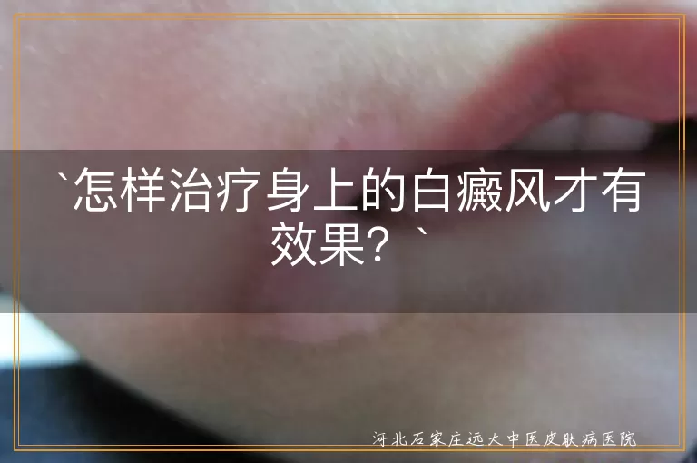 怎样治疗身上的白癜风才有效果？