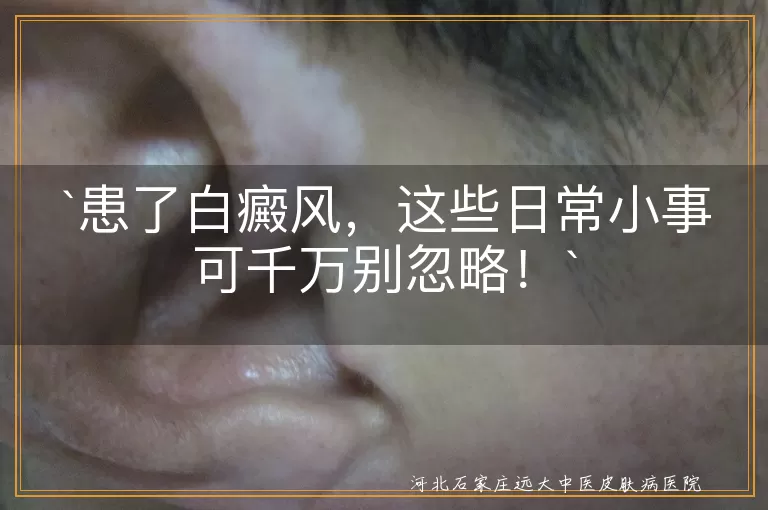 患了白癜风，这些日常小事可千万别忽略！