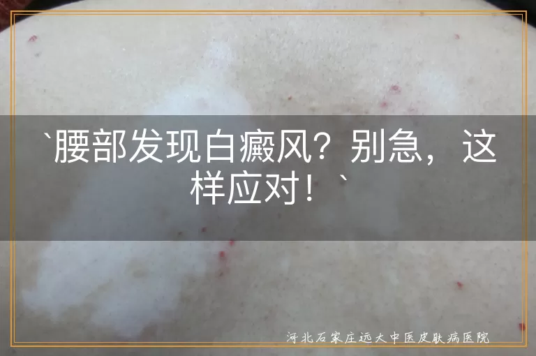 腰部发现白癜风？别急，这样应对！