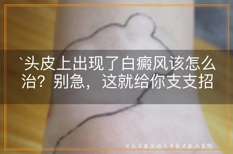 头皮白癜风,治疗,药物治疗,光疗,激光治疗,手术治疗,生活调理