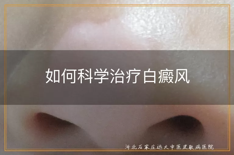 如何科学治疗白癜风