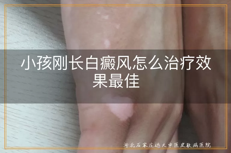 小孩白癜风,治疗效果,综合治疗,日常护理,及时就医,定期复查