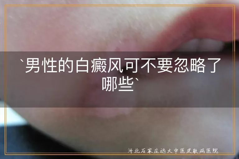 男性的白癜风可不要忽略了哪些