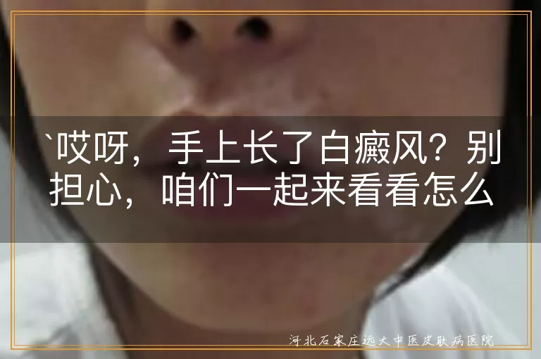 哎呀，手上长了白癜风？别担心，咱们一起来看看怎么治！