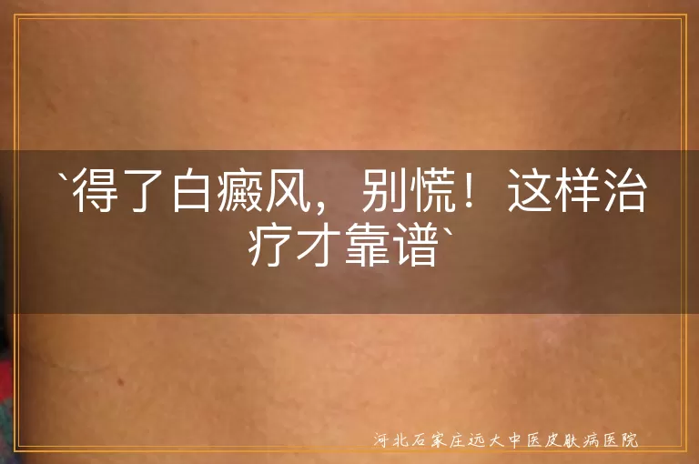 得了白癜风，别慌！这样治疗才靠谱