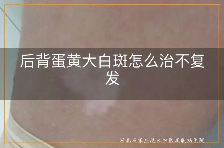 后背蛋黄大白斑怎么治不复发