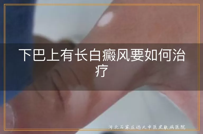 下巴上有长白癜风要如何治疗