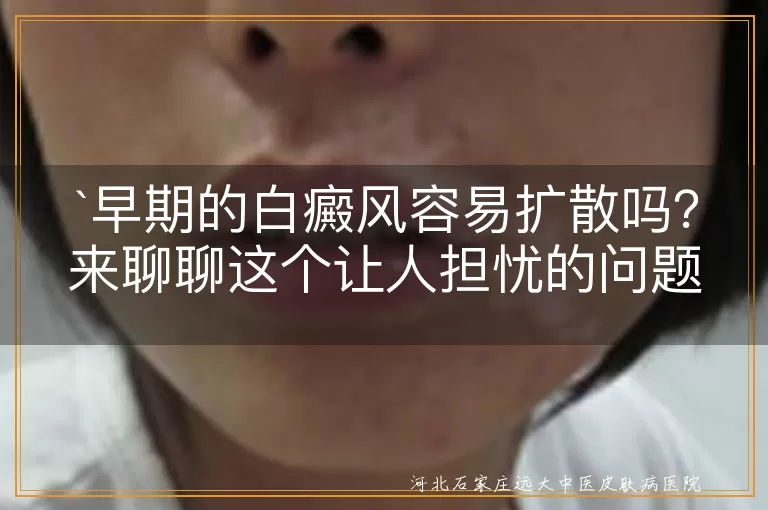 早期的白癜风容易扩散吗？来聊聊这个让人担忧的问题