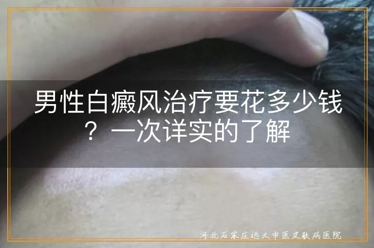 男性白癜风,治疗费用,病情严重程度,治疗方法,正规医院,节省费用