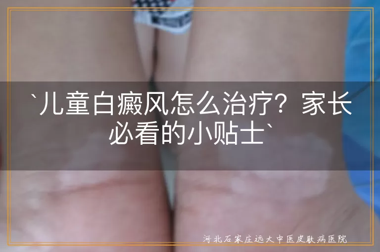 儿童白癜风怎么治疗？家长必看的小贴士