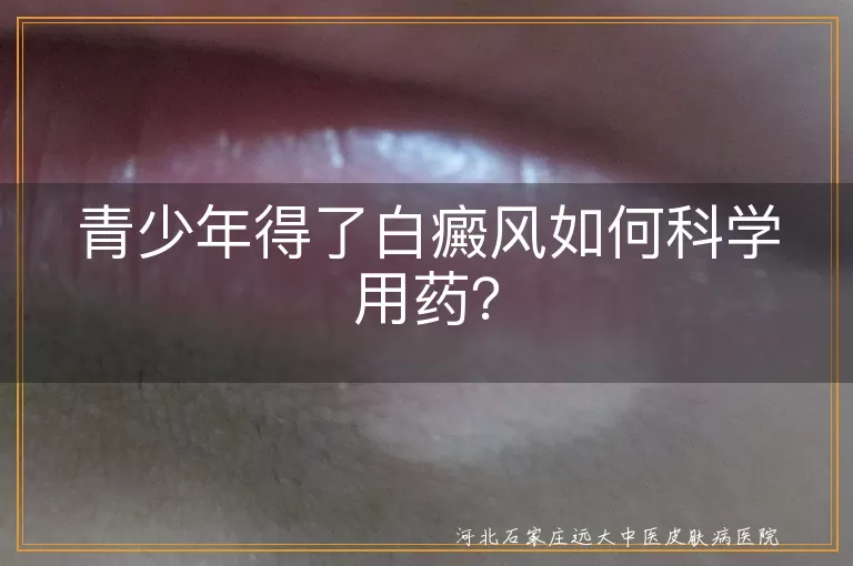 青少年得了白癜风如何科学用药？