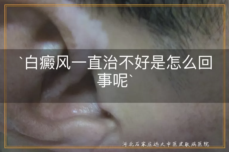 白癜风,难治,病因复杂,个体差异,治疗周期,生活习惯,专业治疗