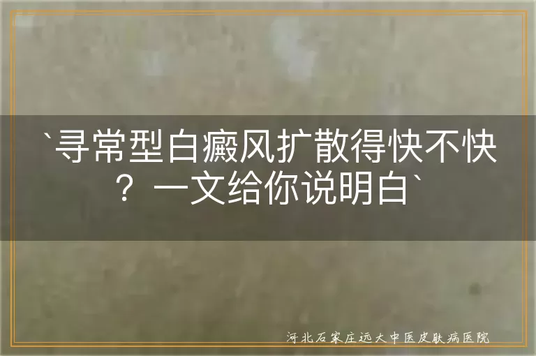 寻常型白癜风扩散得快不快？一文给你说明白