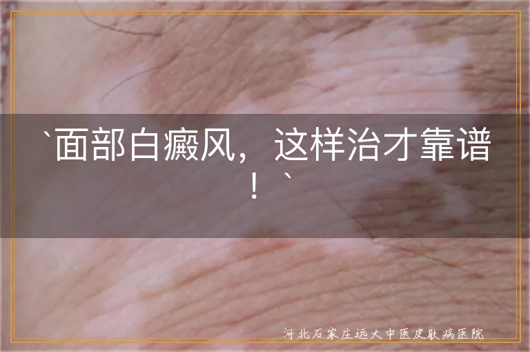 面部白癜风，这样治才靠谱！