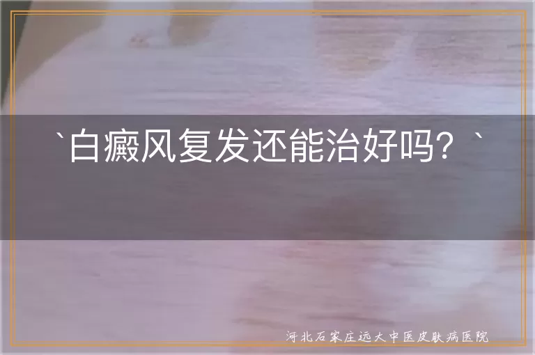 白癜风复发还能治好吗？