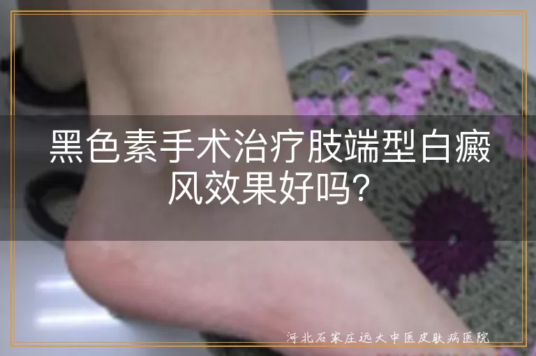 黑色素手术,肢端型白癜风,治疗效果,个体差异,术后护理,治疗方法选择