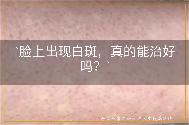 脸上出现白斑，真的能治好吗？
