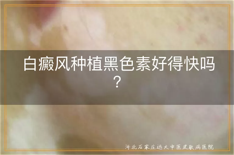 白癜风种植黑色素好得快吗？