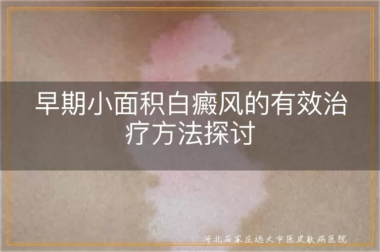 早期小面积白癜风的有效治疗方法探讨