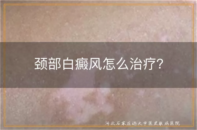 颈部白癜风怎么治疗？