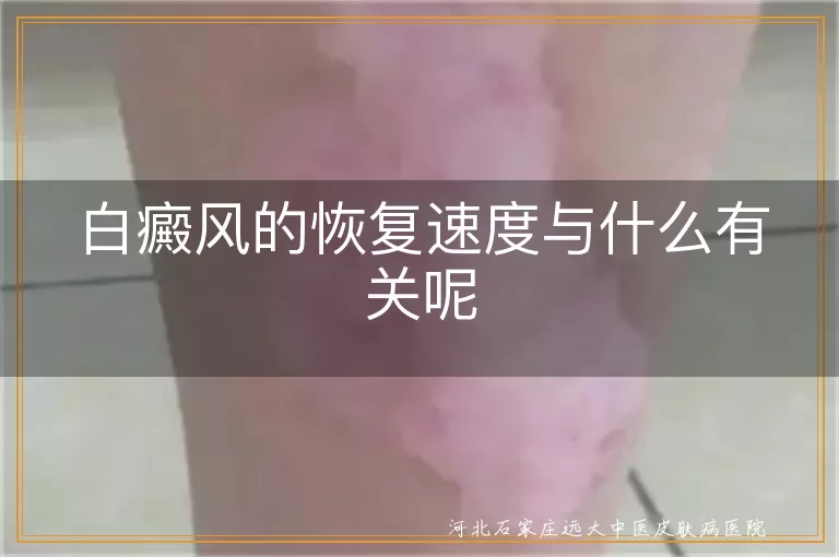 白癜风的恢复速度与什么有关呢