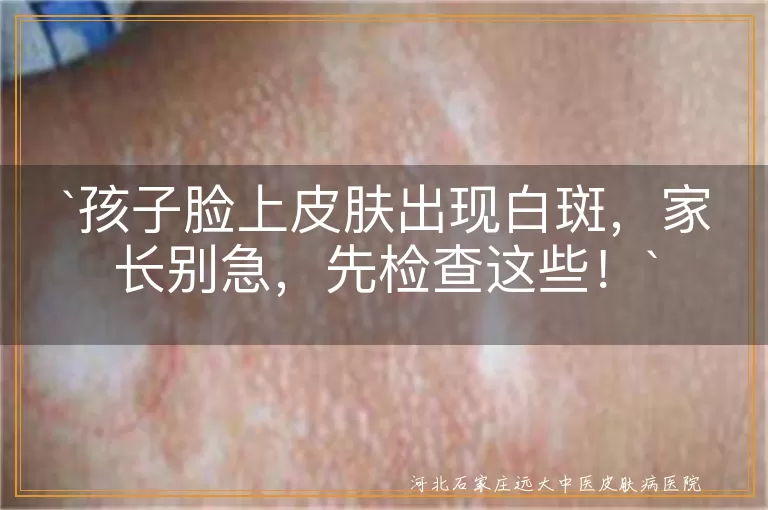 孩子脸上皮肤出现白斑，家长别急，先检查这些！