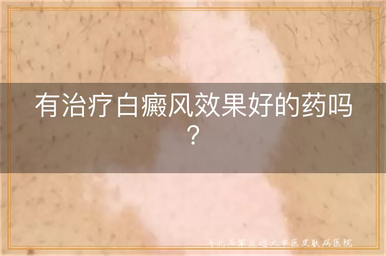 有治疗白癜风效果好的药吗？