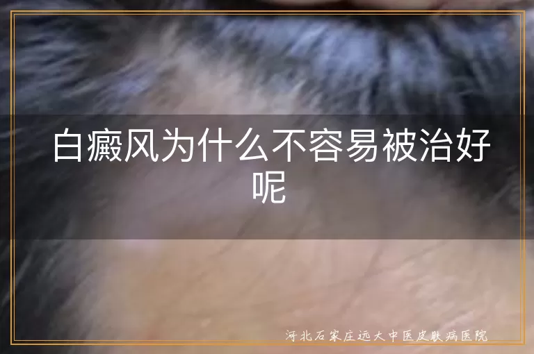 白癜风为什么不容易被治好呢