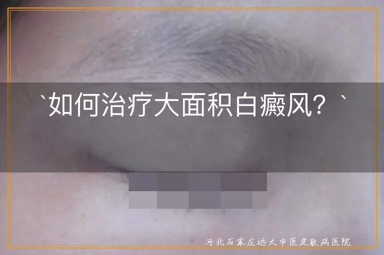 如何治疗大面积白癜风？
