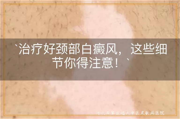 治疗好颈部白癜风，这些细节你得注意！