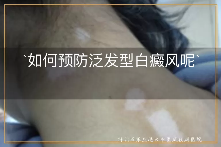 如何预防泛发型白癜风呢
