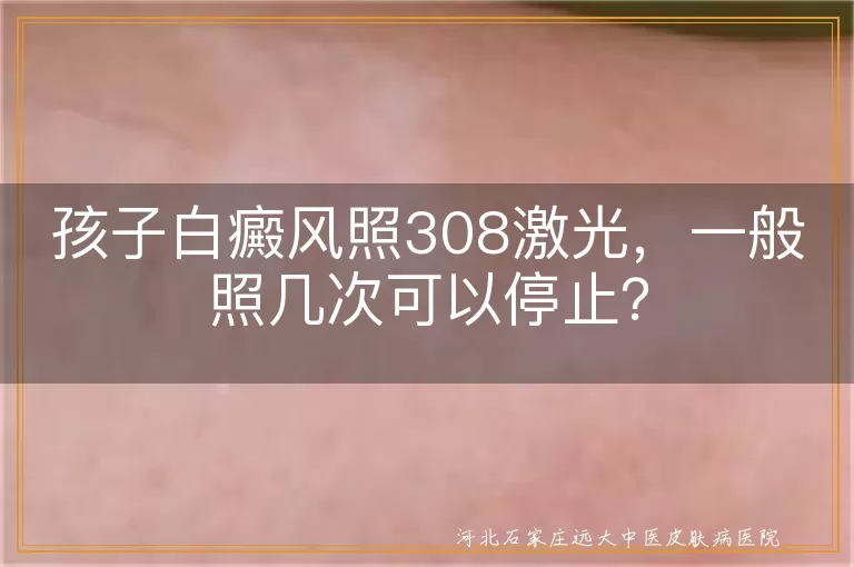 孩子白癜风照308激光，一般照几次可以停止？