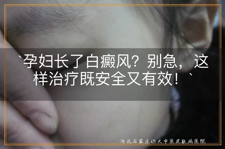 孕妇长了白癜风？别急，这样治疗既安全又有效！