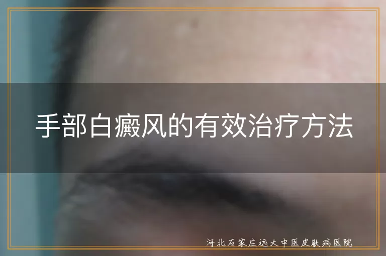 手部白癜风的有效治疗方法