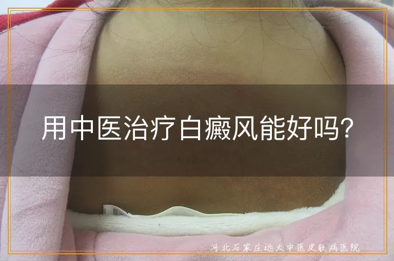 用中医治疗白癜风能好吗？