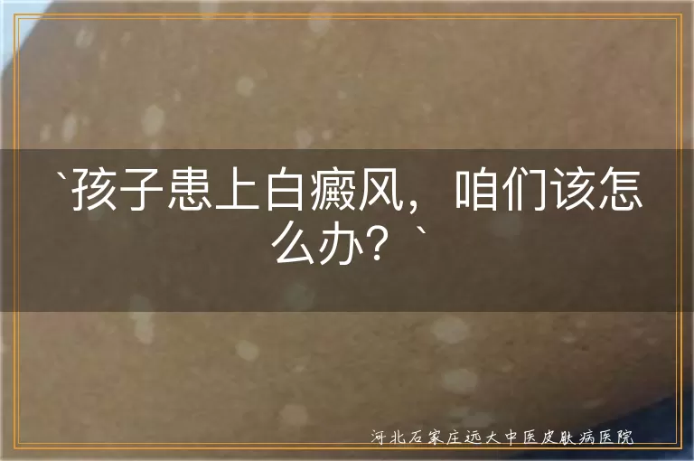 孩子患上白癜风，咱们该怎么办？