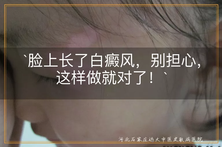 脸上长了白癜风，别担心，这样做就对了！